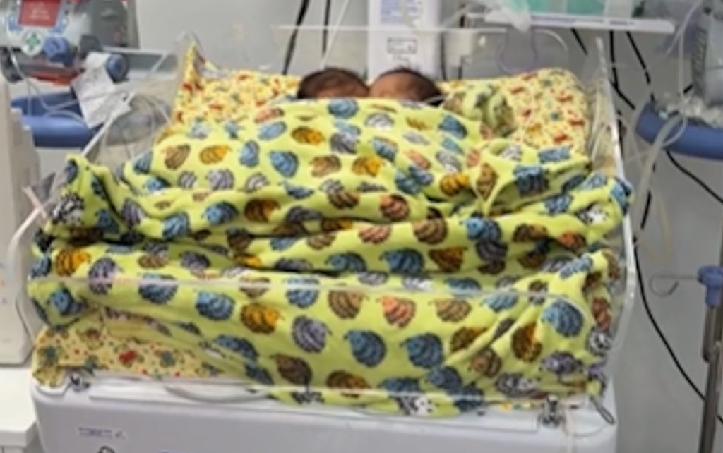 Bebês siameses que nasceram unidos pelo abdômen morrem em Goiânia